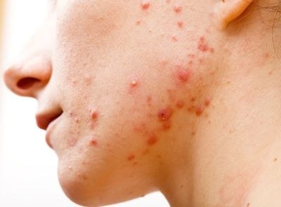 Isotretinoïne inzetbaar bij kinderen met acne